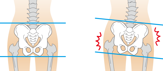 腰椎椎間板ヘルニア