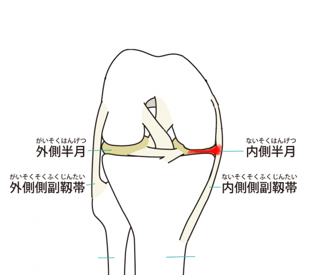 変形性膝関節症