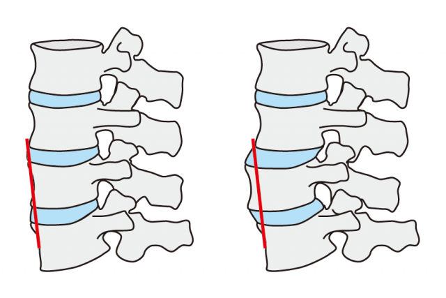 腰椎すべり症