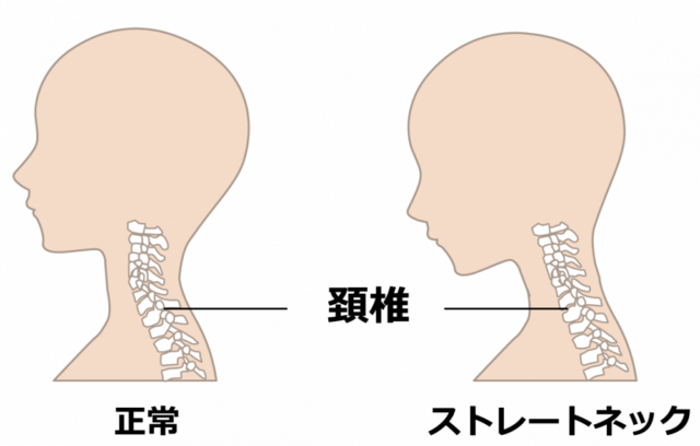 ストレートネック