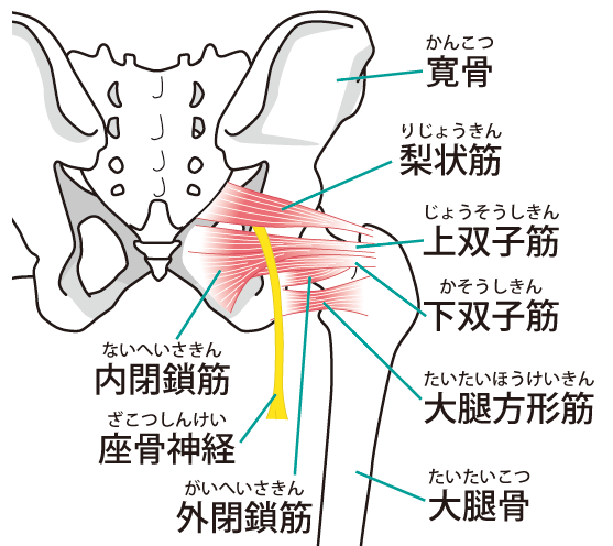 梨状筋症候群